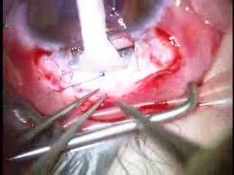 Trabeculotomy Surgery Technique (Video)