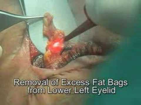 Blepharoplasty with CO2 Laser (Video)