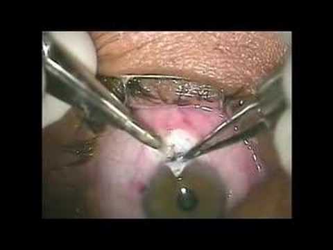 Trabeculectomy with fornix flap