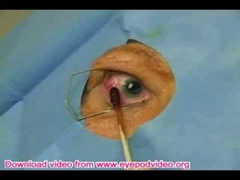 How to Inject Intravitreal Drugs (Video)