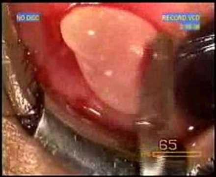Cysticercus Eye Removal (Video)
