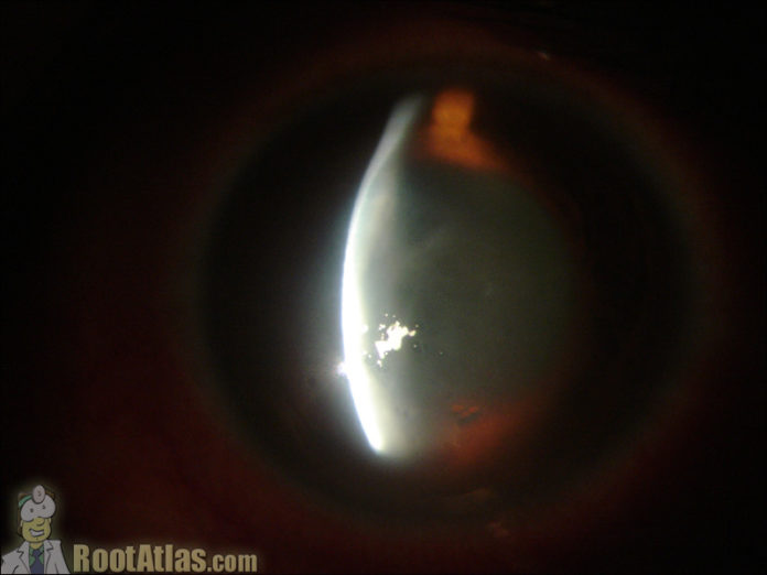 Corneal Edema from Hydrops (Photo) - TimRoot.com