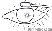 inf-cornealulcer.jpg