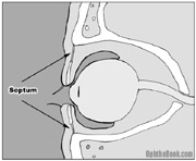 inf-septum.jpg