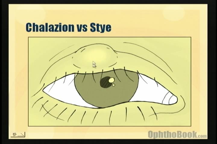 infection-chalazion.jpg