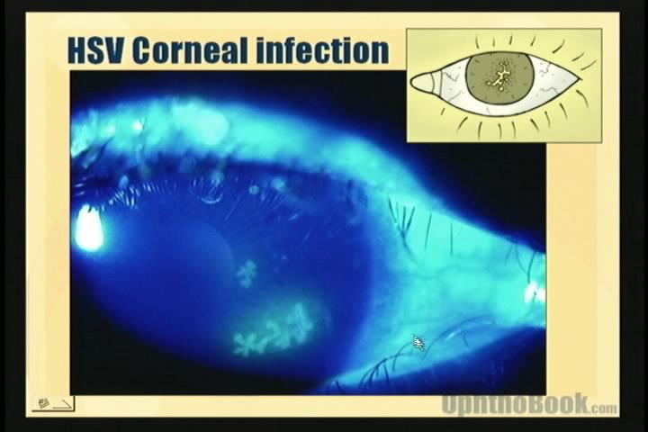 infection-hsv.jpg