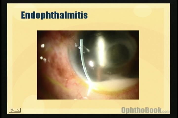 anterior chamber cell