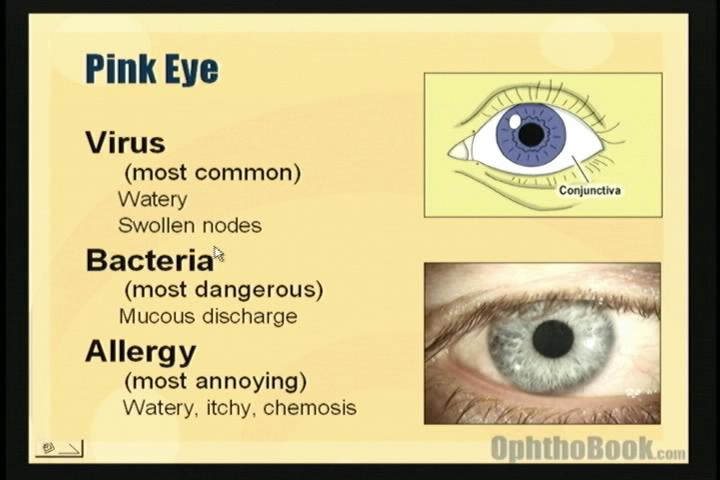 difference between viral and bacterial pink eye