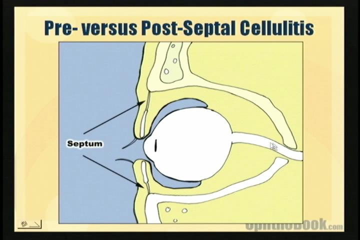 anatomy orbital cellulitis