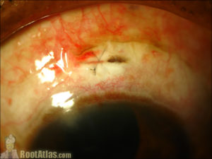 Scleral Tunel