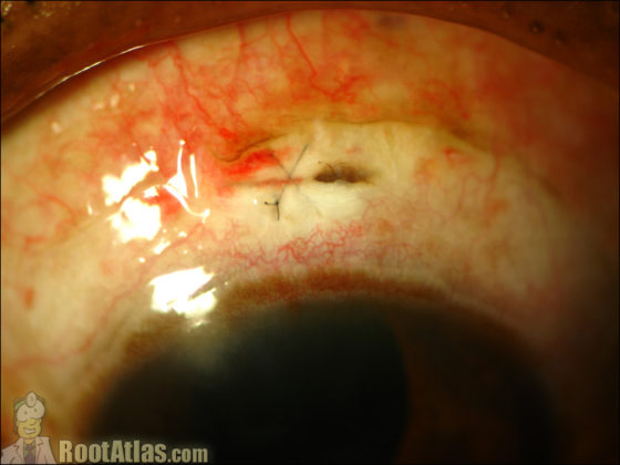 Small incision cataract surgery video download