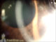 KP (keratic precipitates) on the back of the cornea (Video) - TimRoot.com