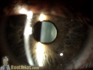 Lens sutures