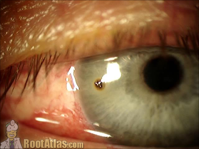 corneal rust ring