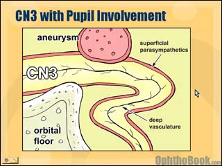 neurovideo-aneurysm.jpg