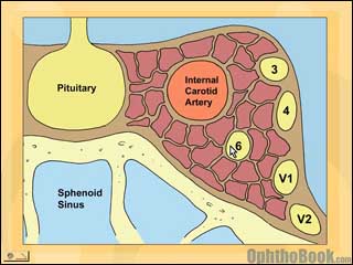 neurovideo-cavernoussinus.jpg