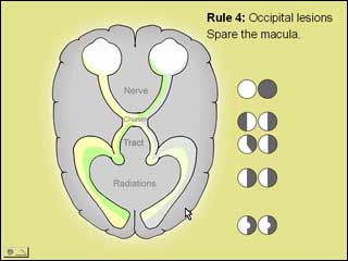 neurovideo-visualfield.jpg