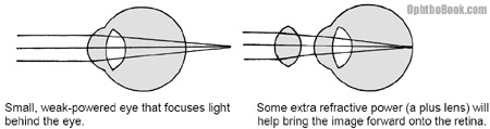 opt-hyperopiceye.jpg