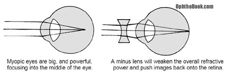 opt-myopiceye.jpg