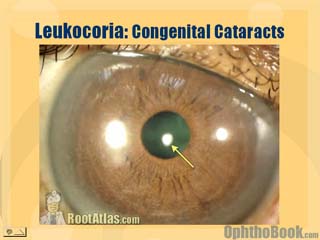 Leukocoric white pupil