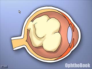 Retinoblastoma