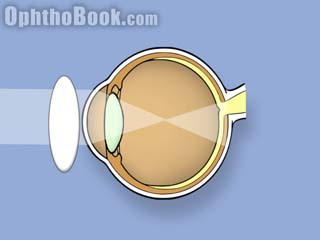 How to retinoscopy