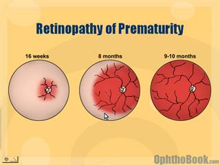 Retinopathy of Prematurity