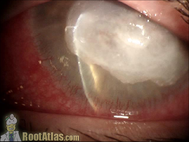 Perforated Corneal Ulcer (Photo)