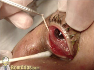 Pseudomembrane Eye