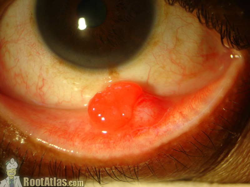 pyogenic granuloma eye
