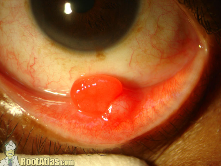 Pyogenic Granuloma of the Eyelid (video)