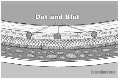 dot blot hemorrhages