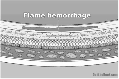 retinal flame hemorrhage