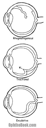 ret-retinaldetachmenttypes.jpg