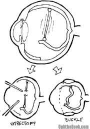 ret-retinalrepair.jpg