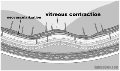 ret-vitreouscontraction.jpg