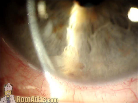 retained lens material following cataract surgery of right eye icd 10