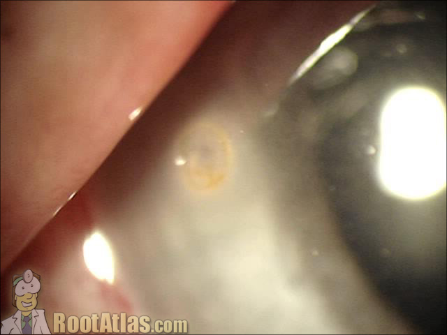 corneal rust ring