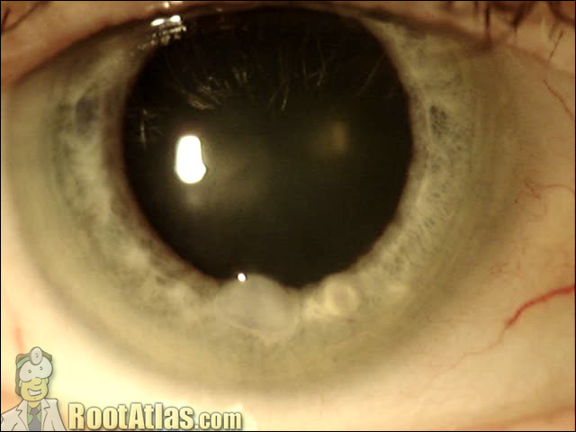 Photo: Salsman’s degeneration nodule on cornea