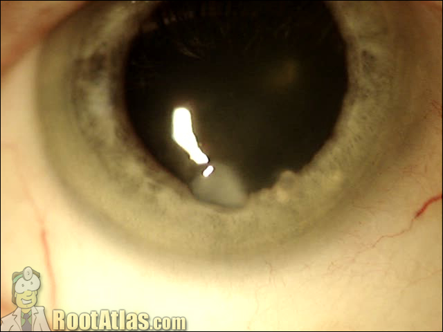 Photo: Salzman’s degeneration on the cornea