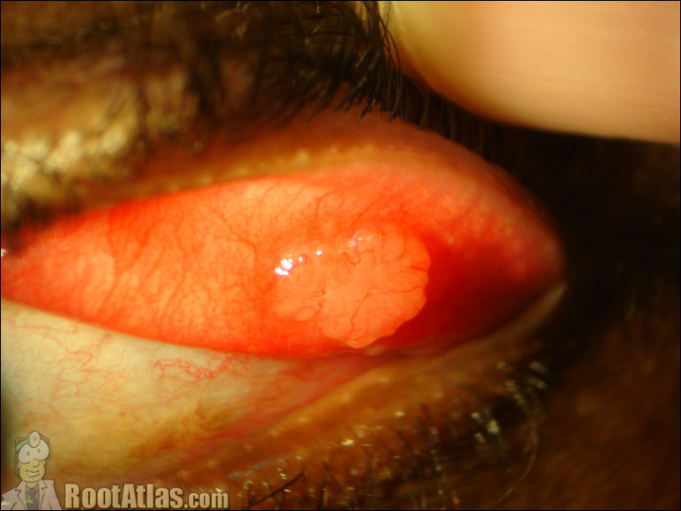 Photo: Sarcoid nodule on the inner eyelid