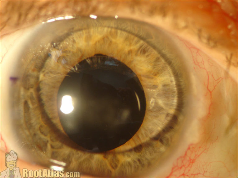 Silicone oil in the anterior chamber (photo)