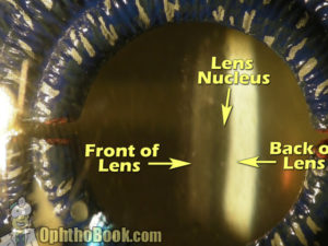 Cataract Cross-section