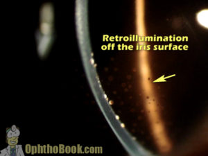 Retroillumination off the iris