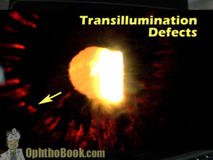 Transillumination Defects