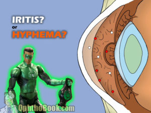 Iritis versus Hyphema