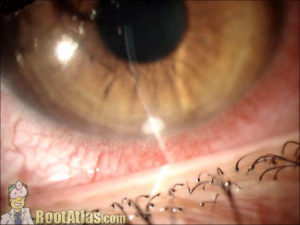 Staph marginal keratitis