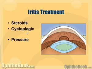 Iritis treatment