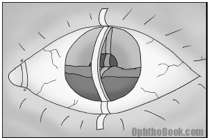 trm-hyphema.gif