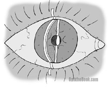 trm-traumaticiritis.jpg